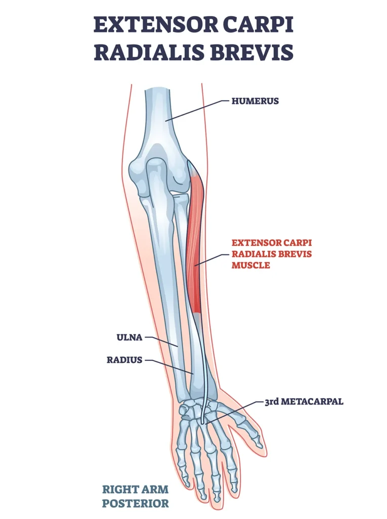 Illustrazione anatomica dell'epicondilo laterale e dei muscoli estensori del polso